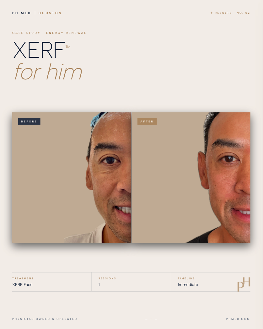 XERF for Him Results