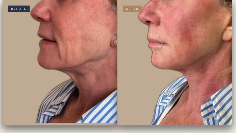 XERF before and after, female patient, Houston Heights