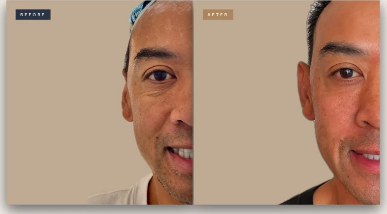XERF before and after, male patient, Houston Heights