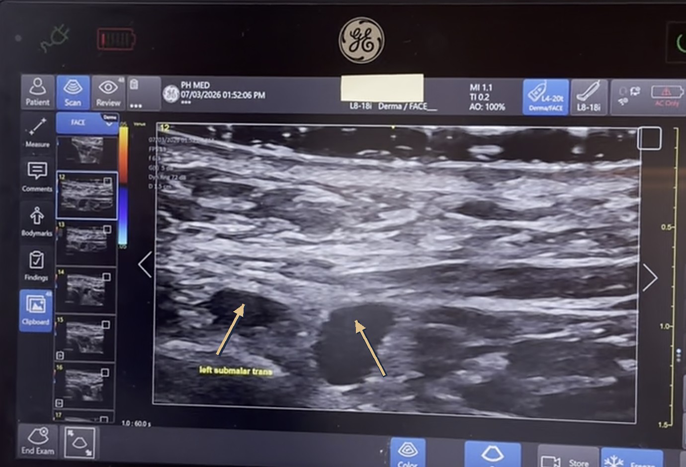 Ultrasound imaging showing dermal filler placement at PH Med Houston Heights