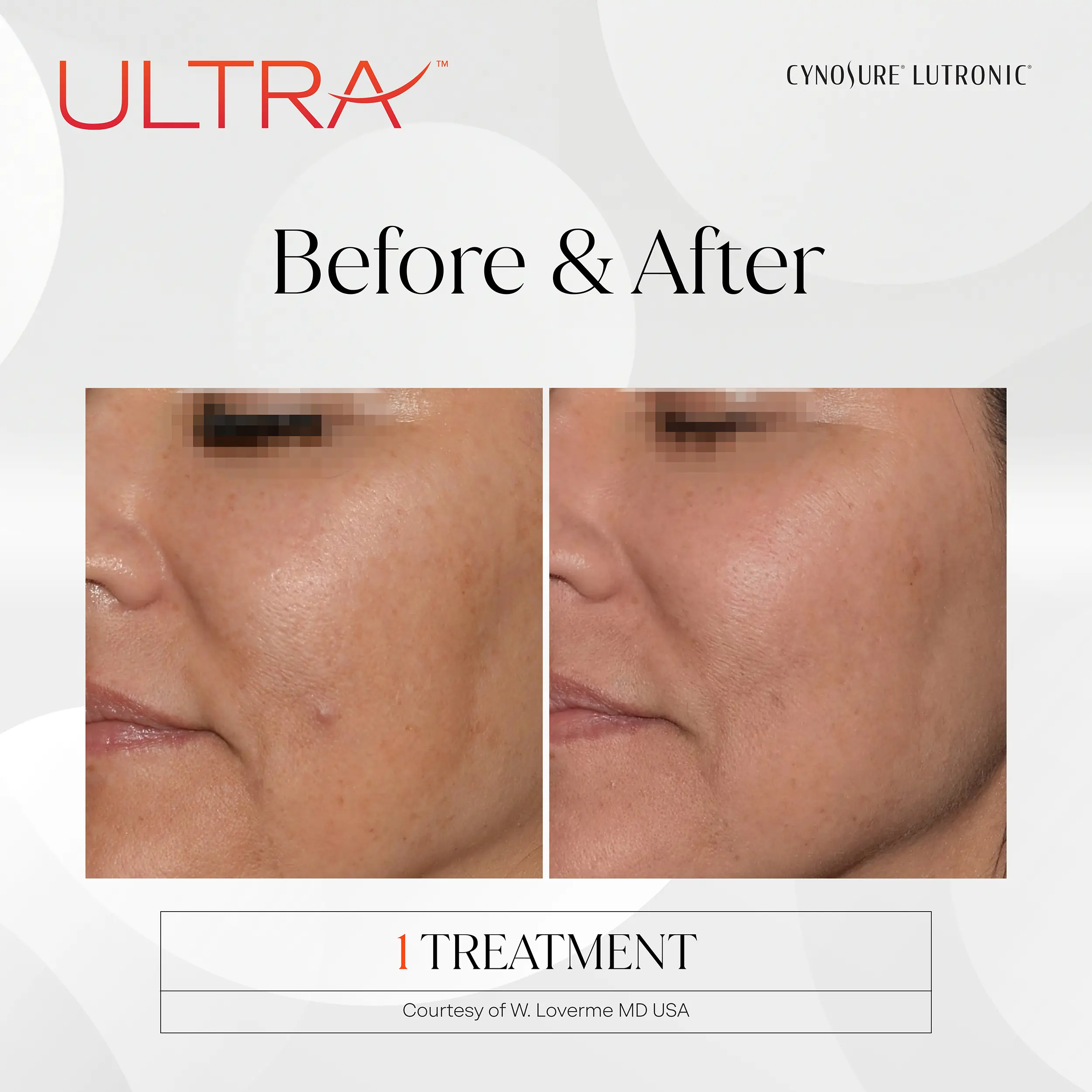 LaseMD Ultra skin treatment promotional image at PH Med Houston